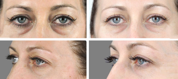 PRP-dark-circles-treatment-before-after