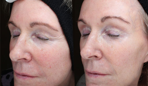 collagen-boost-before-after