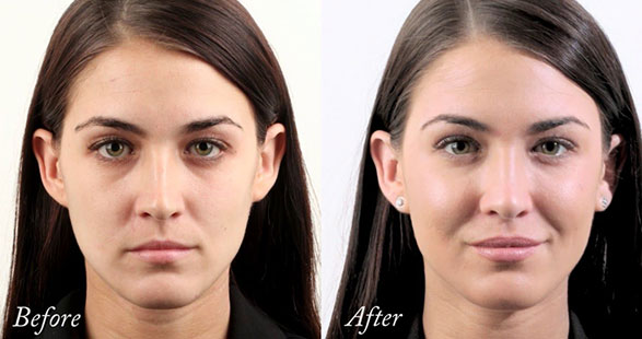 DERMAL FILLERS IN CHANDIGARH: 7 WAYS TO IMPROVE YOUR FACIAL APPEARANCE
